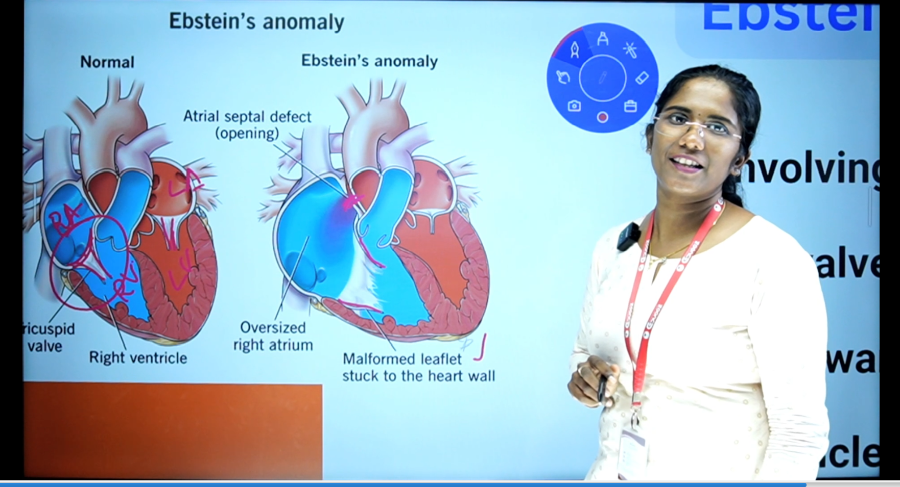 Lecture slide explaining Ebstein's anomaly, a congenital heart defect